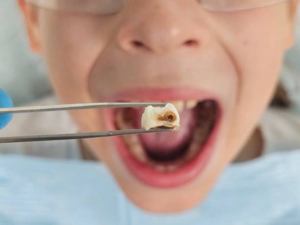 Best Emergency Treatment for Dental Infections or Abscesses in Lovington, NM